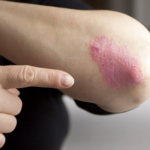 Forskare: Psoriasis kan självläka